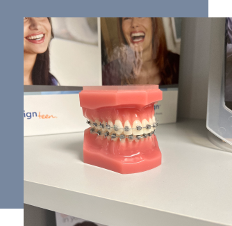 model of teeth with braces on them